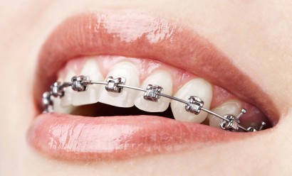 Cabinet orthodontie Liberation regles orthodontie