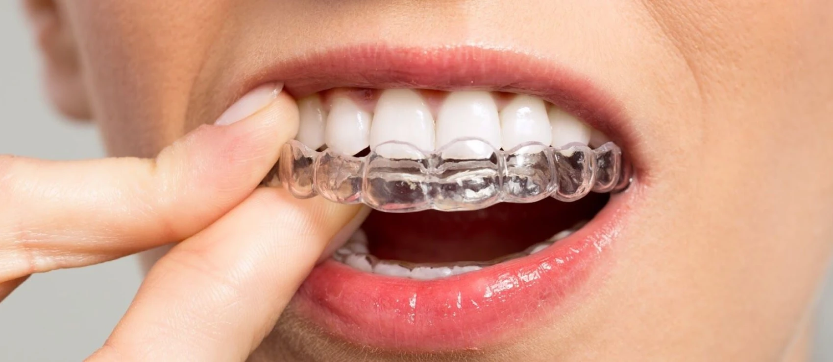 Orthodontie après la ménopause