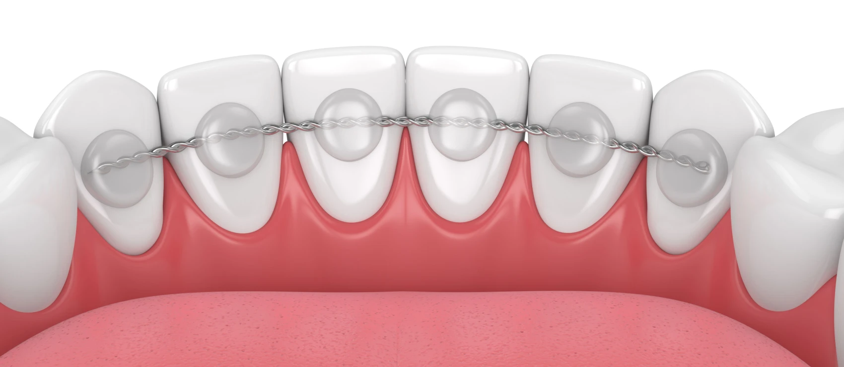 La contention en orthodontie : essentielle après un traitement