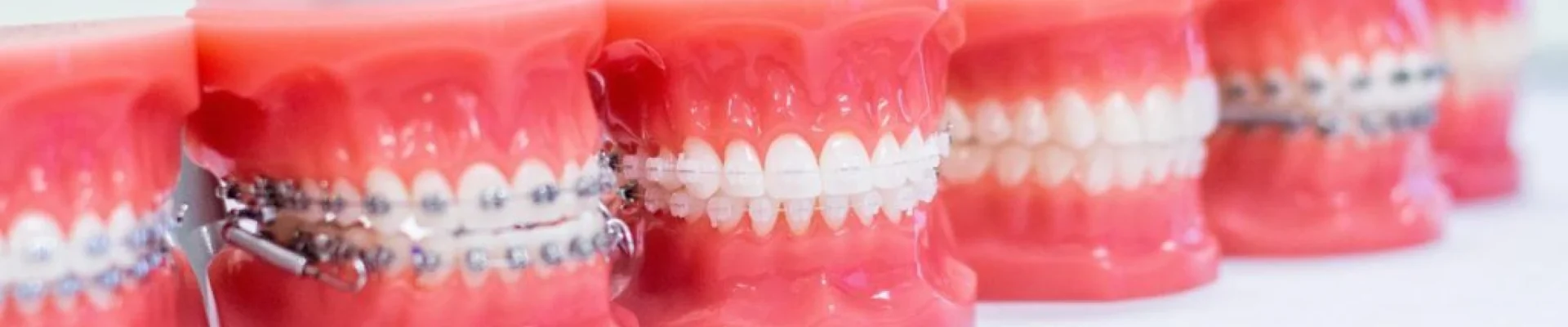 L'orthodontie et le bien-être mental : Boostez votre confiance grâce à un sourire aligné L'orthodontie et le bien-être mental : Boostez votre confiance grâce à un sourire aligné