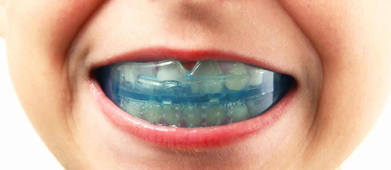 Orthodontie et sport : comment concilier les deux en toute sérénité ?