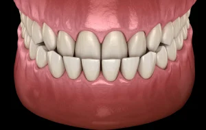 Différences entre malocclusion, chevauchement et encombrement dentaire