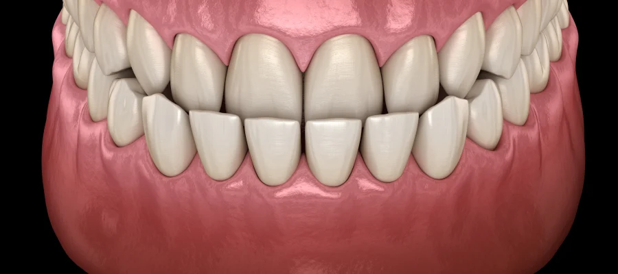 Différences entre malocclusion, chevauchement et encombrement dentaire