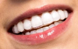 Serrer les dents : que raconte cette expression de nos tensions invisibles ?