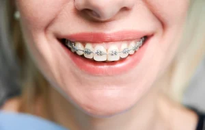 Orthodontie & grossesse : peut-on porter un appareil pendant la grossesse ?