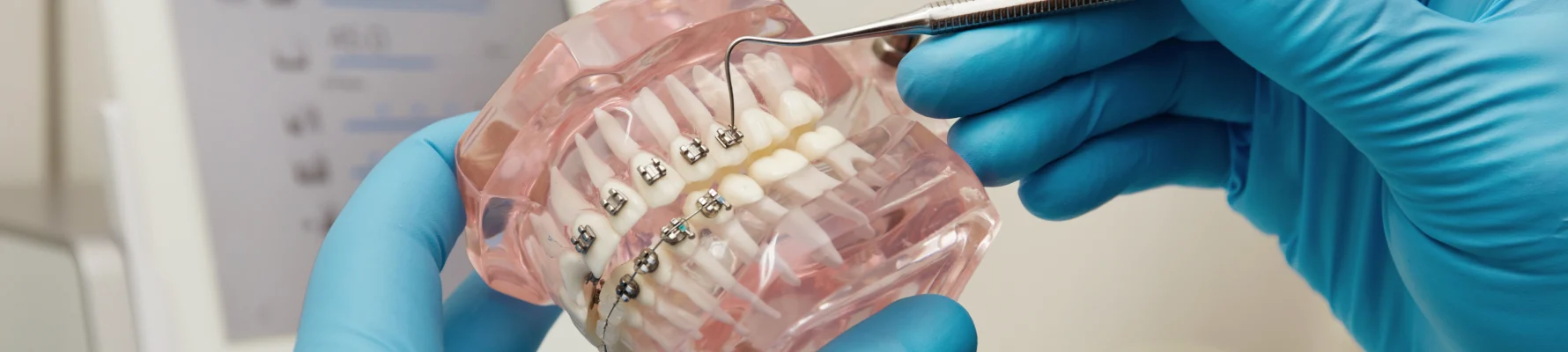 Urgences orthodontiques : un bracket se décolle ou un aligneur se casse