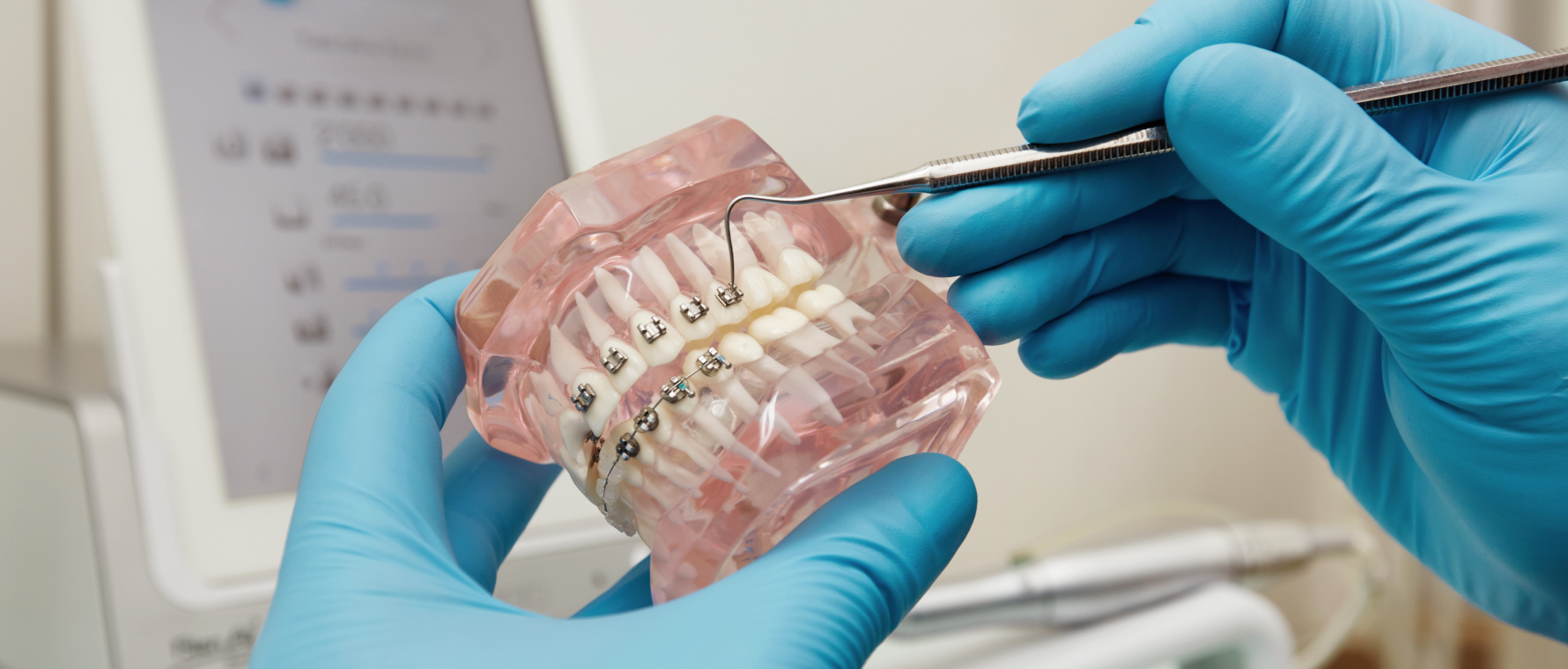 Urgences orthodontiques : un bracket se décolle ou un aligneur se casse