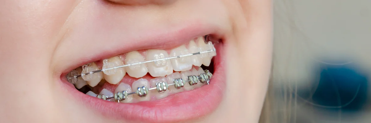 Orthodontie & parodontite : peut-on aligner les dents malgré une gencive fragile ?